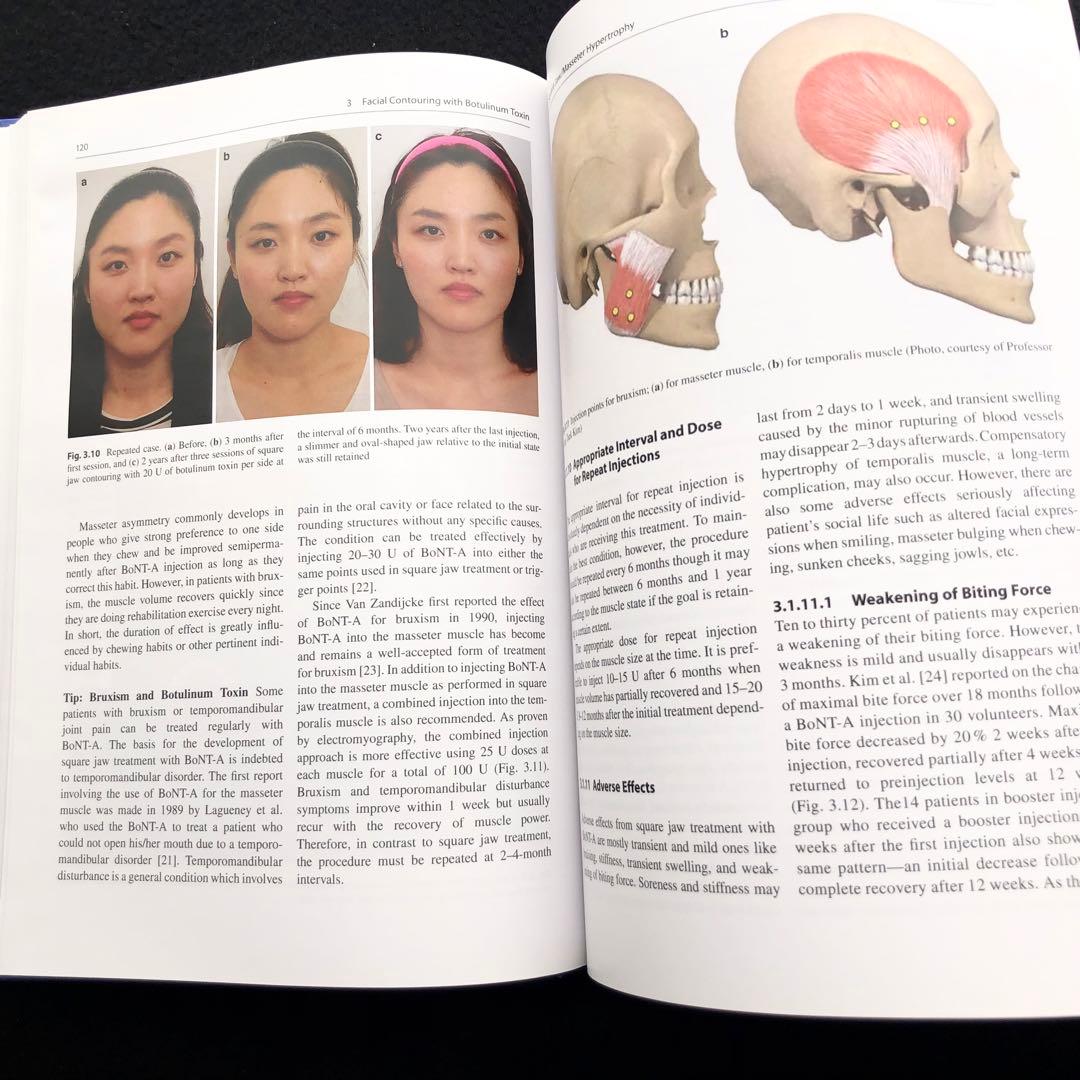 アジア人のためのボツリヌストキシン「Botulinum Toxin」